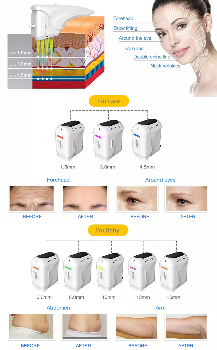 Norin 2 in 1 hifu korea / 4D hifu face lift vaginal tightening beauty machine for salon