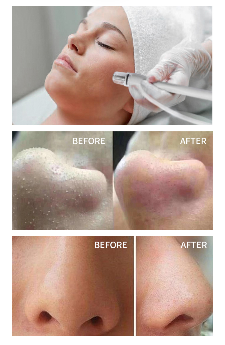 Diamond Microdermabrasion Machine Small bubbles skin Deep Clean Blackhead Remover Vacuum Beauty Device SPA9.0