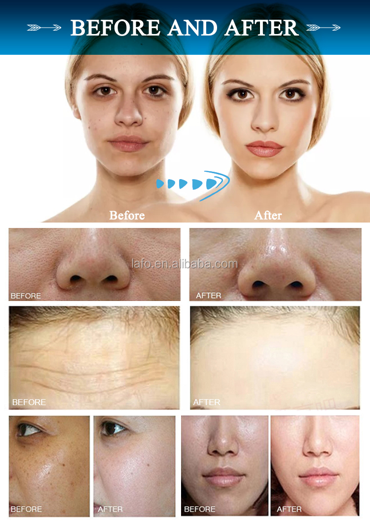 portable Hydro water dermabrasion facial machine / 5 in 1 multifunction skin face beauty instrument LF-836A