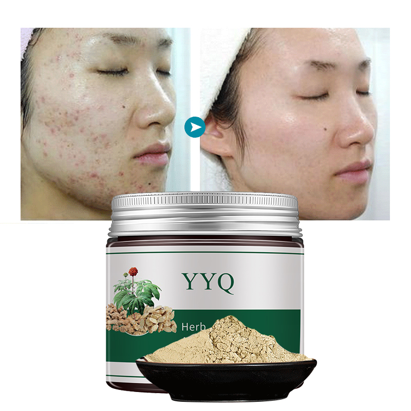 OEM/ODM частная этикетка на заказ, китайские травы, лечение акне, удаление лекарственных порошков, уход за кожей лица