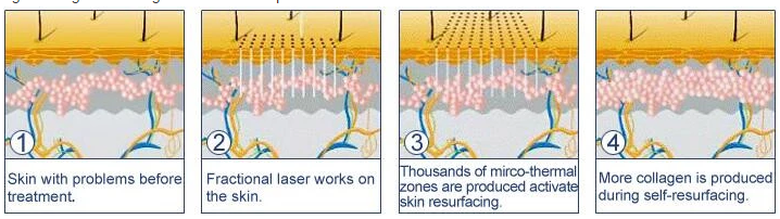 処置の僅かのlazerの二酸化炭素レーザーの打抜き機に新しい表紙を付けるFotonの発電機の医学の皮