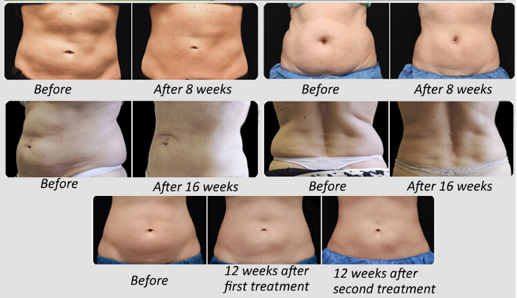 Cryo Weight Loss Slimming Cryolipolysis Fat Removal Freezing Body Sculpting Machine for Salon