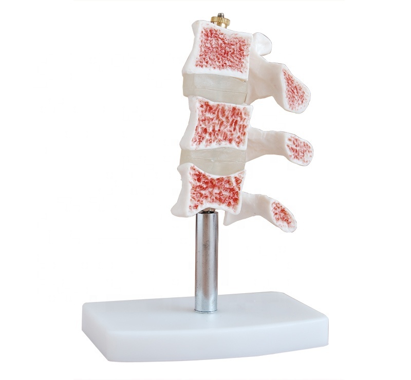 Human Cutaway Osteoporosis PVC material school medical teaching training model BC1025-34