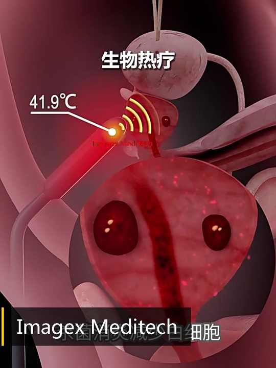 Non-Invasive Therapy Device for Prostate Relief| Alibaba.com