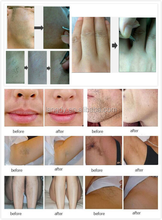 Super Nano Light OPT SHR IPL for hair removal/skin rejuvenation/Vascular Therapy & Breast lift