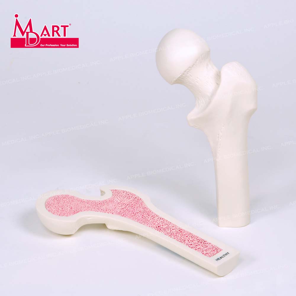 Распродажа образцов болезни остеопороза с полезной секцией на модели кости бедренной кости человека.