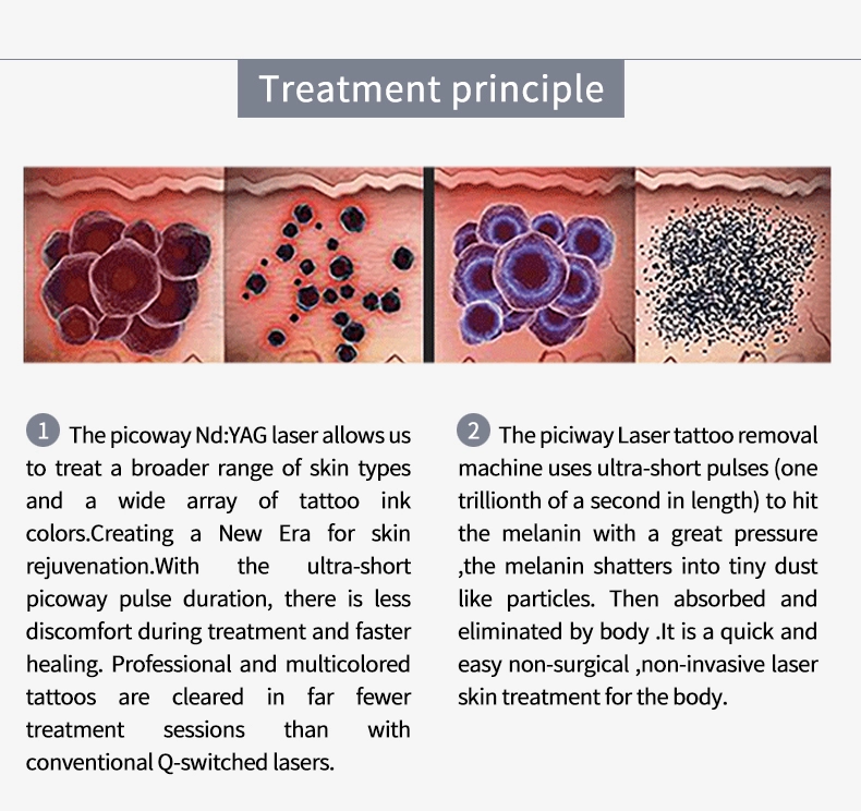 Precio de fábrica 532nm 755nm 1064nm Q conmutado Nd Yag láser de eliminación de tatuajes Picosecond máquina láser Picosur 4