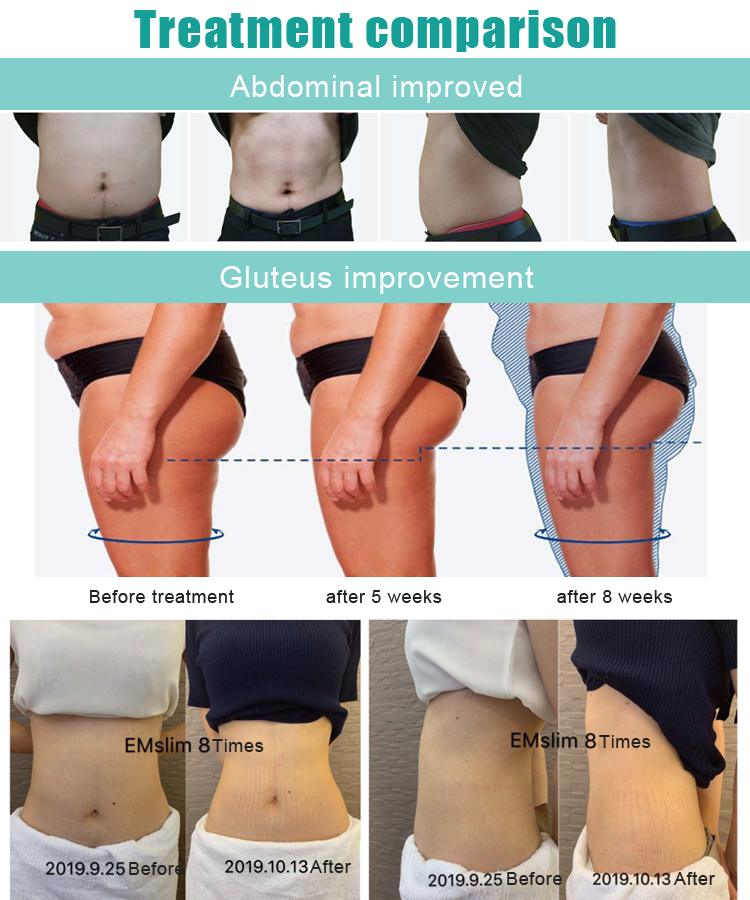 Aesthetics Sculpt Hiemt Machine Slim Beauty Lose Fat And Gain Muscle Intelligent