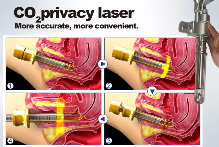 Lasylaser-CO2-Bruchlaser-Maschine für das Vaginafestziehen und Dehnungsstreifennarbenabbau