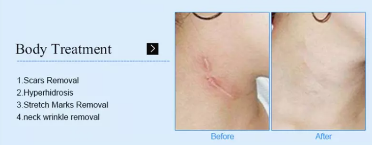 fractional micro needle microneedling rf radio frequency microneedle skin tightening salon use rf beauty machine