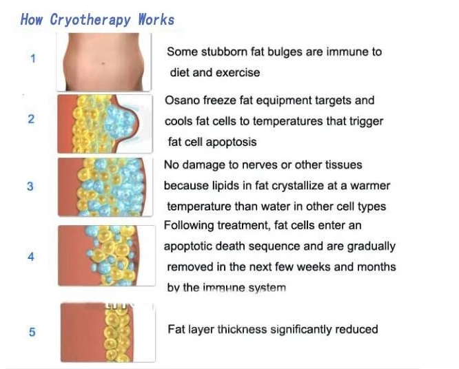 Niansheng 5 CRYO Handles Fat Freeze Slimming Machine 4 Handles Working Together 360 Degree Cryo Slimming Machine
