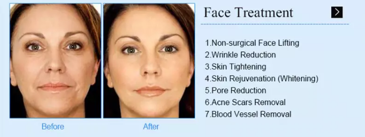 fractional micro needle microneedling rf radio frequency microneedle skin tightening salon use rf beauty machine
