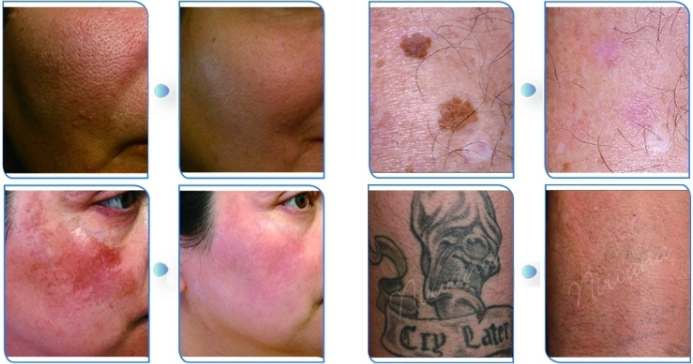Picosecond tattoo removal machine