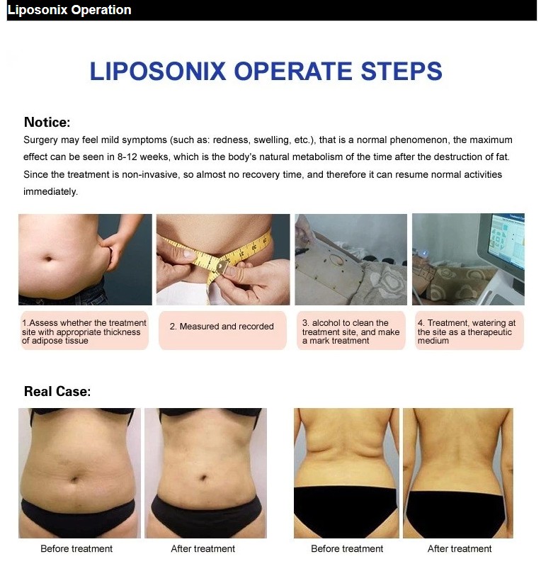 Hello Body! newest home use portable liposonix machine on sale