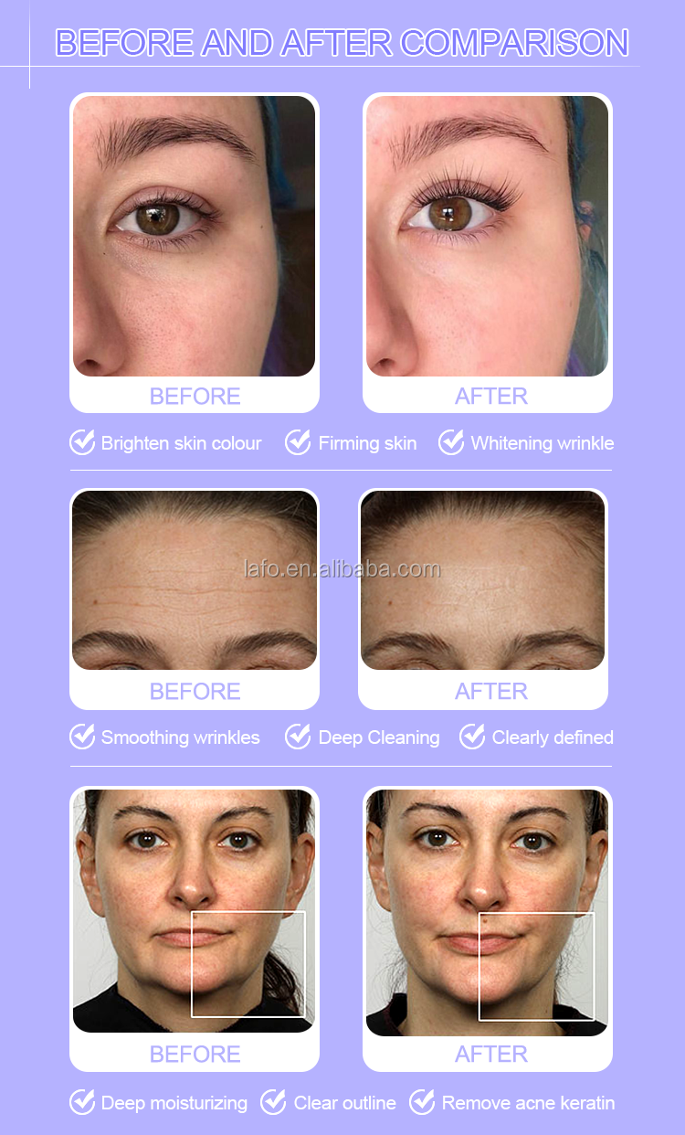 HOTTEST 11 in 1 multifunction microdermabrasion professional hydro dermabrasion / microdermabrasion machine