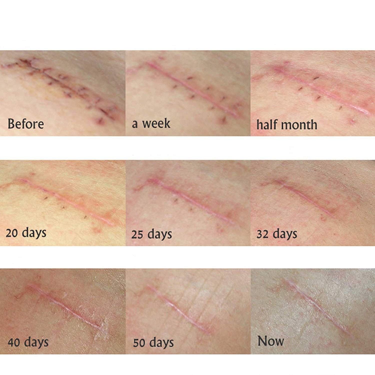 Wholesale High Quality Organic Repair Acne Scar Removal Cream