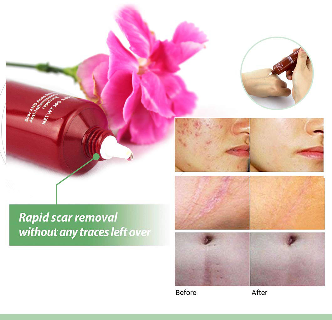 Wholesale High Quality Organic Repair Acne Scar Removal Cream
