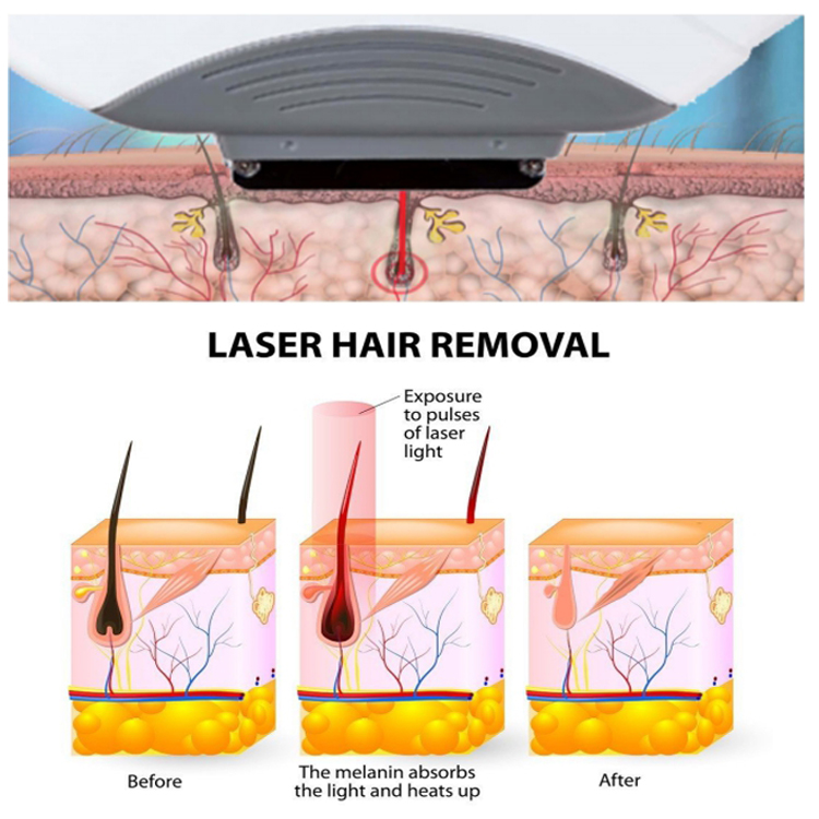 2021 newest ipl hair removal laser made in germany