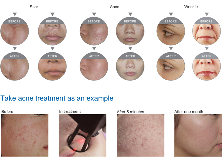 RF Fractional CO2 Laser Germany 4D Fotona Laser System For Stretch Marks Scar Removal Vagina Tighten Skin Rejuvenation