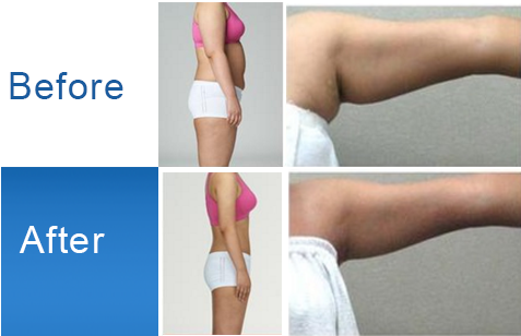 Hifi Giá Slimming Liposonic Lipo Sonix Máy
