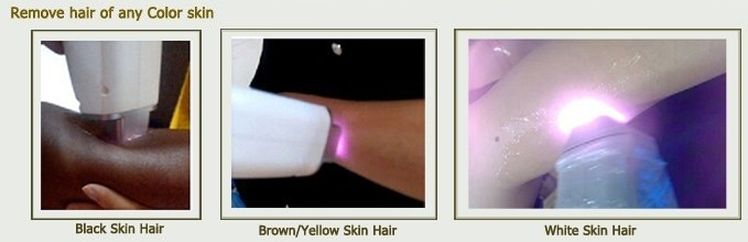 Professional laser machine hair removal depilation alexandrite 808 diode laser hair removal