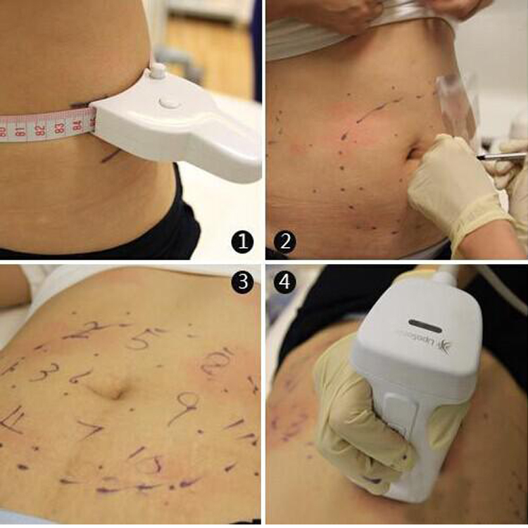 Hifi Giá Slimming Liposonic Lipo Sonix Máy