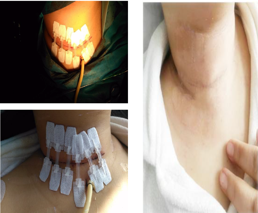 无缝线的拉链伤口闭合装置 - buy wound closure,zip wound closure