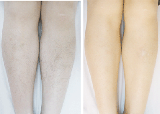 Langdi IPL SHR Hair Removal Machine Diode Laser Hair Removal Machine