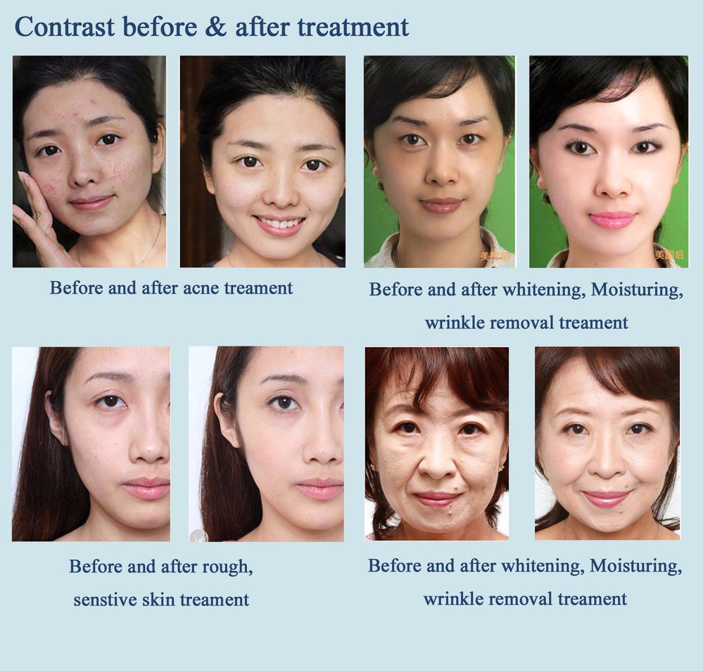 Langdi IPL SHR Hair Removal Machine Diode Laser Hair Removal Machine