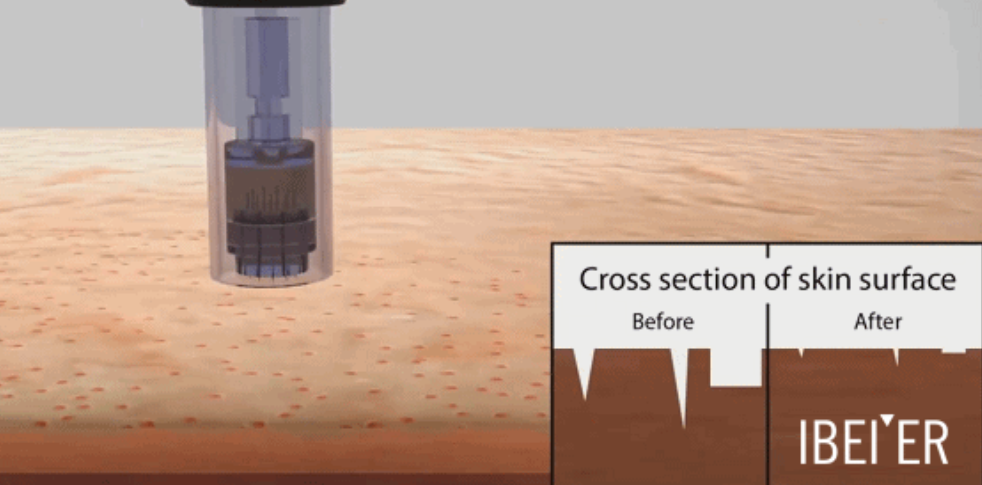 Nutri pen magical cosmetology micro needle pen electric meso micro cartridge option microneedling pen