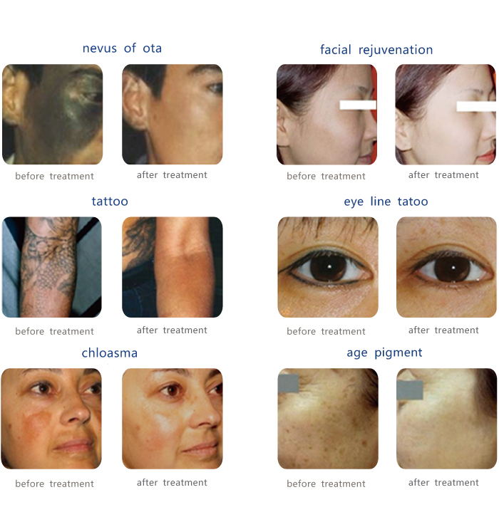 Beijing KES portable laser tattoo removal machine MED-810