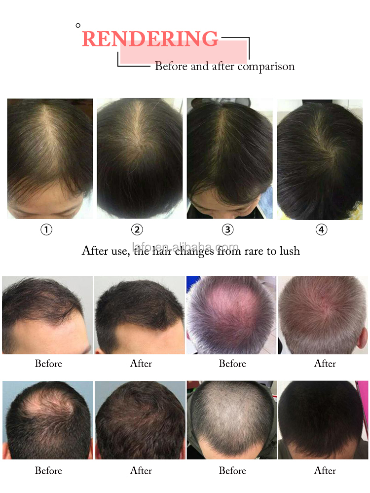 Effective 650nm diode laser hair regrowth treatment machine / anti-hair loss beauty machine LF-361