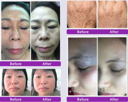 Picosecond tattoo removal machine
