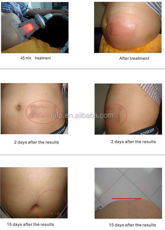 LF-253 Portable one big cryo handle Cryolipolysis Fat Dissolving Machine With CE