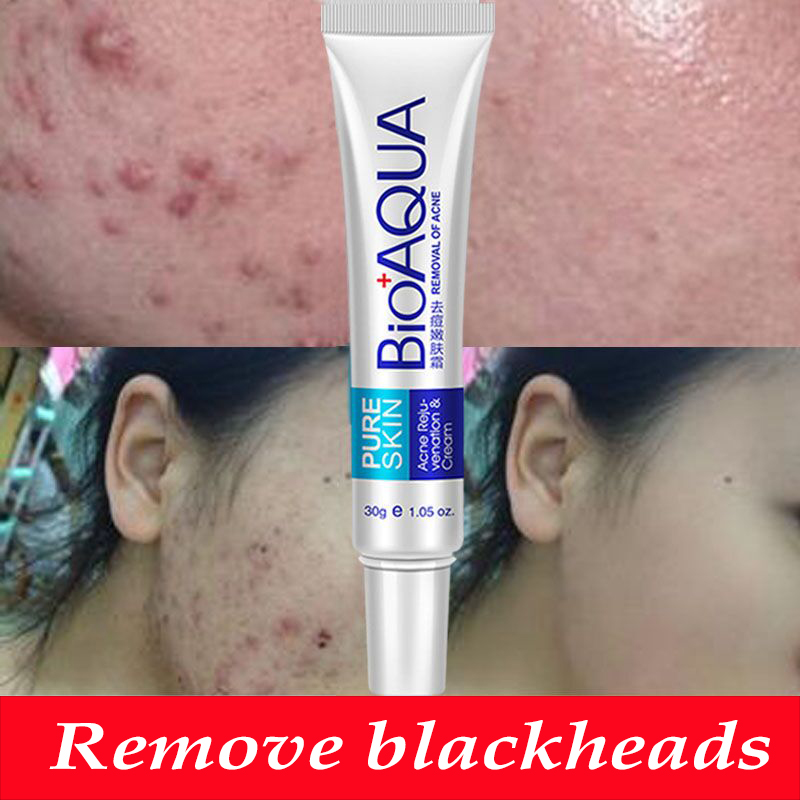 BIOAOUA 30g Acne Treatment Blackhead Remova Anti Acne Cream Oil Control Shrink Pores Acne Scar Remove Face Care Whitening