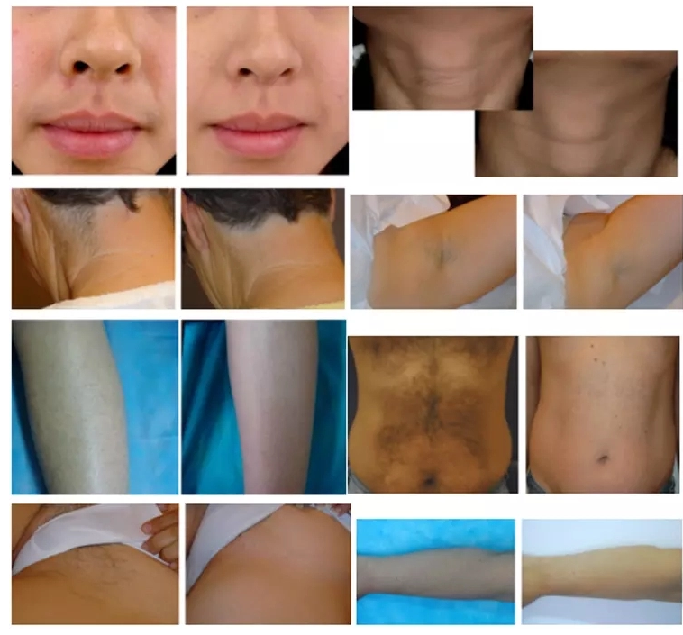 Niansheng Professional 755nm 808nm 1064nm  Laser Hair Removal Skin Rejuvenation Beauty Machine
