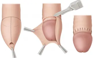 3R Hot Sale Certificate Disposable Urology Male Genital Plastic Surgery Device Foreskin Cut Circumcision Stapler//
