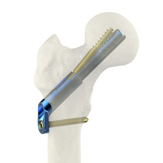 Proximal femoral femur titanium locking plate placa ortopedica minimal invasive femur double medical titan implants
