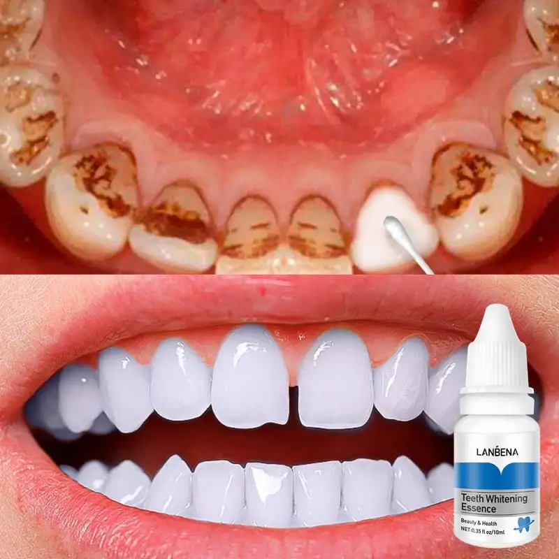 LANBENA professional easy white teeth whitening essence liquid