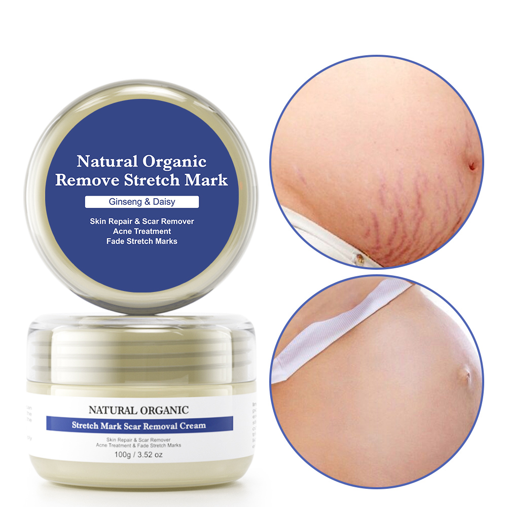effective stretch marks cream natural organic pregnancy stretch mark removal cream
