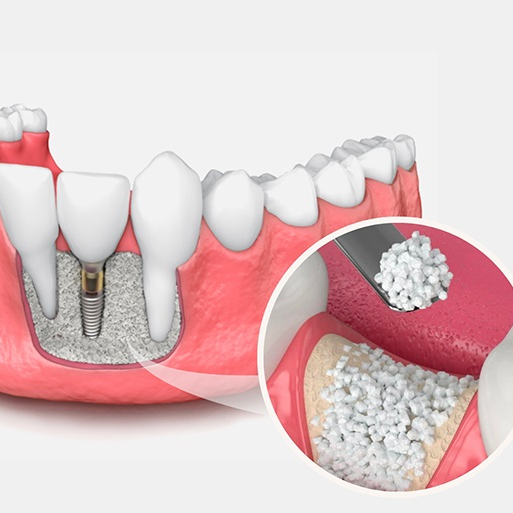 Bone Graft Material 0.5G Dental Good Quality Bone Substitute Powder Bone Repair Biodegradable Healing CPC
