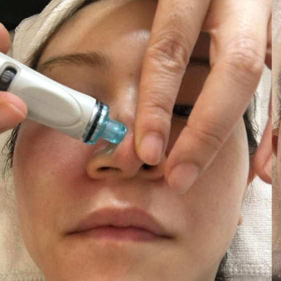Original tips of hydra beauty facial machine