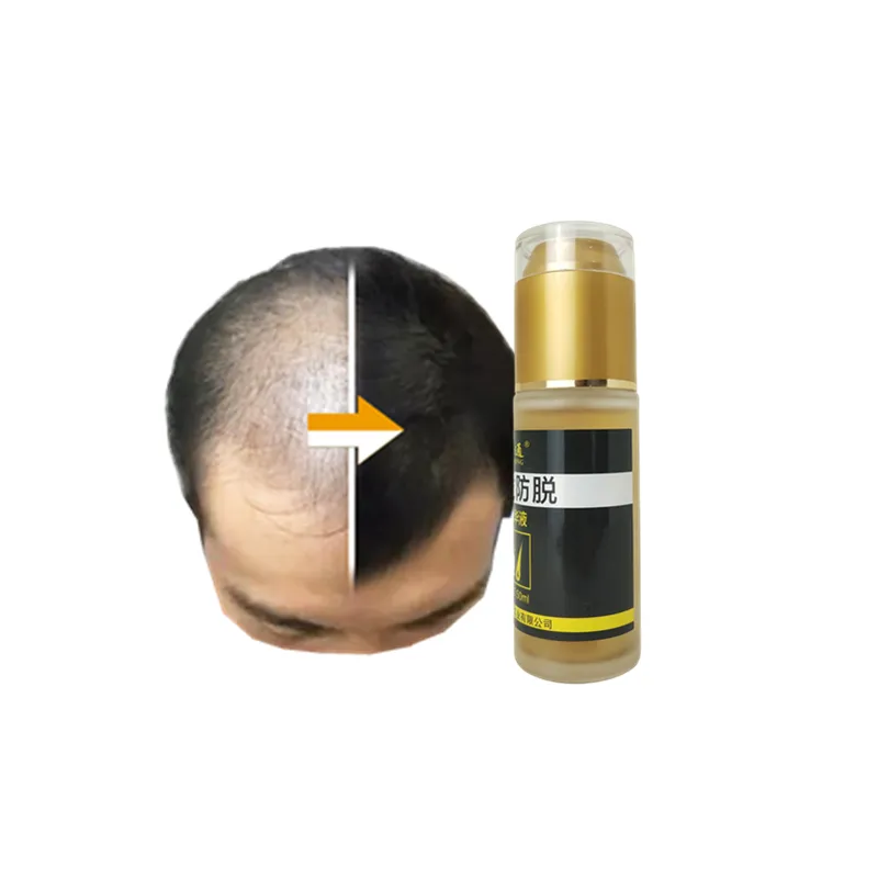 Hair growth oil baldness regrowth treatment for bald hair