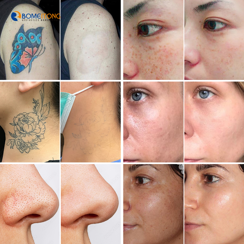 Factory Outlet Black Face Doll skin Whitening Profesional Portable Picosecond Laser Machine 5 In 1