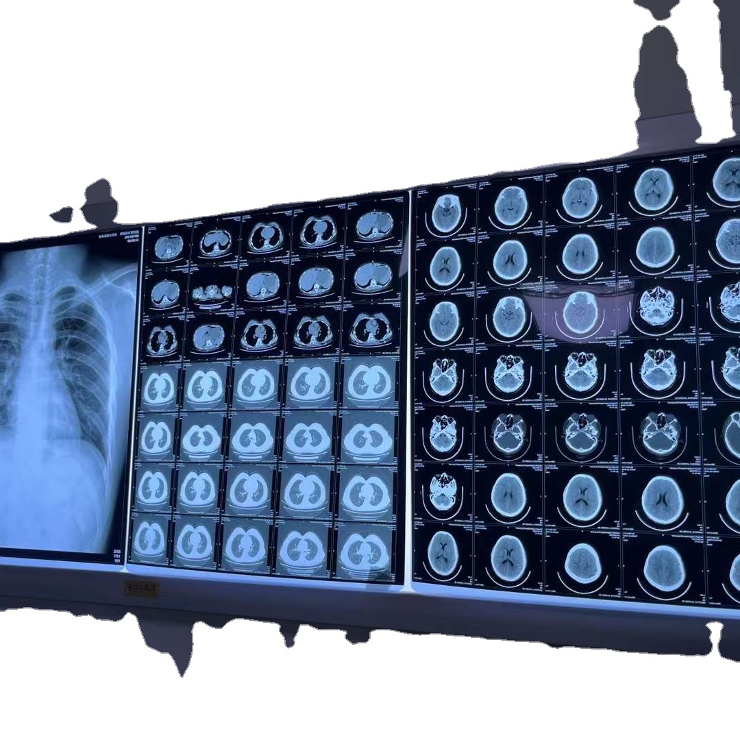 Portable 100ma X-Ray Equipment & Accessories Radiology Essential for Diagnostics