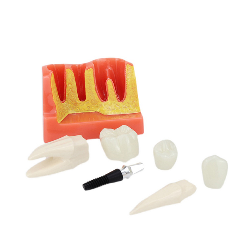 4 Times Implant Dental Teaching Model Removable Teeth Model Implant Model/Mentor Implant