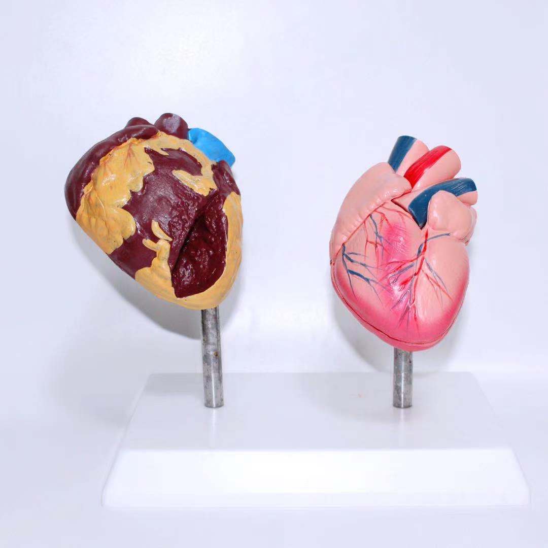 Factory - sold realistic and durable anatomical demonstration model of a healthy human heart compared with a smoking heart