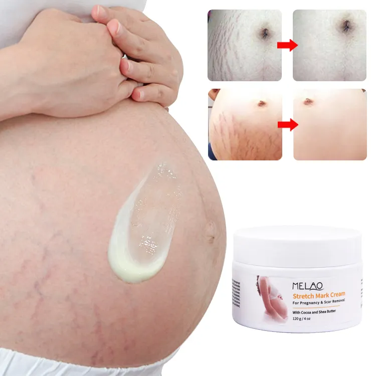 MELAO Organic Mom Acne Scar Repair Stretch Mark Removal Cream Anti Stretch Mark Cream Body Care For Women Private Label