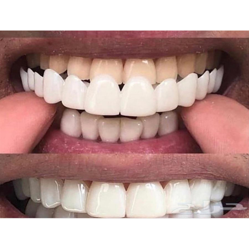 Oral Upper Lower Teeth Cover customized label snap on smile Veneers Dentures Teeth Whitening Braces dientes odontologa
