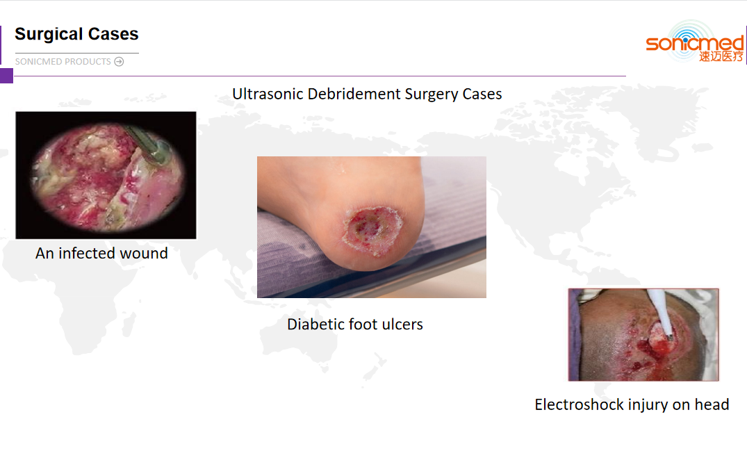 USI1001 Trauma Surgery Wound Debridement Devices Ultrasonic Surgical System
